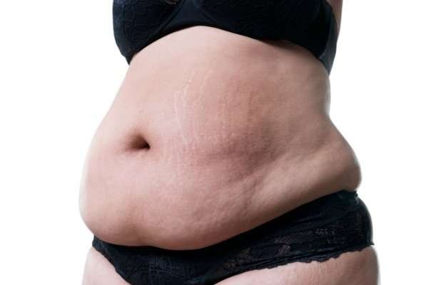 Am I too fat for a Tummy Tuck?