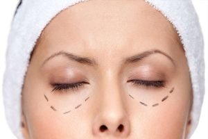 blefaroplastia sin cirugia