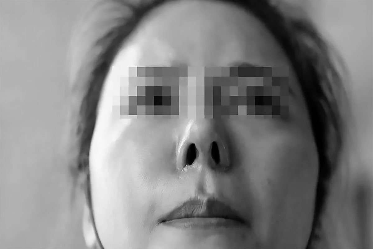 rinoplastia mal hecha
