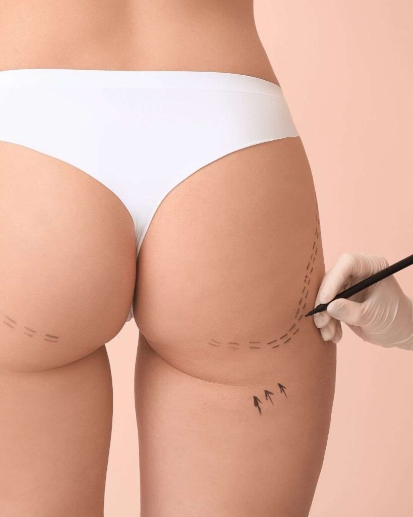 Cirugía Gluteoplastía