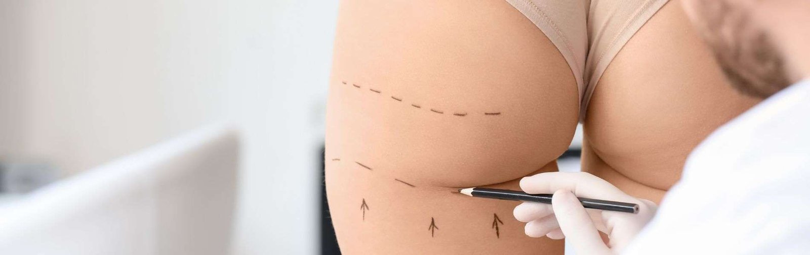 Lipoinyeccion Glutea D - Cirugía Plástica Todo Incluido en Colombia