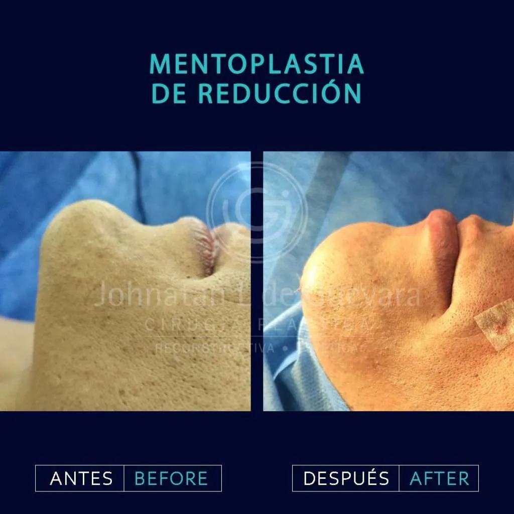 Mentoplastia 1 - Mentoplastia cirugía del mentón Bogotá