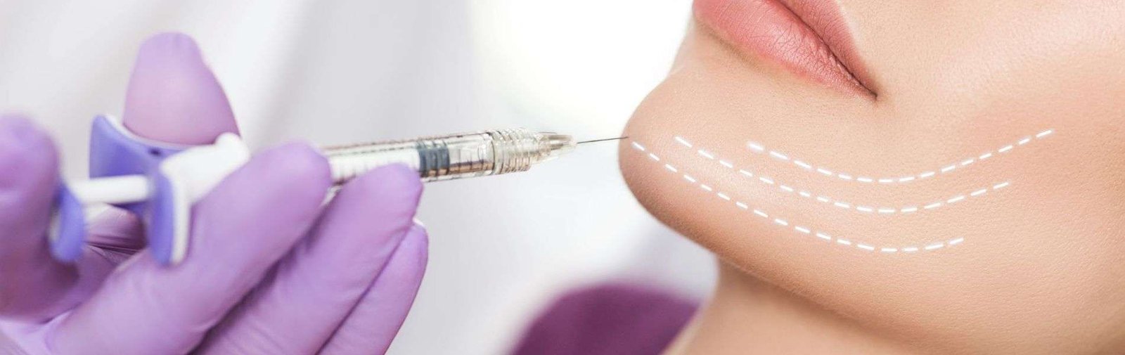 Mentoplastia C - Mentoplastia cirugía del mentón Bogotá