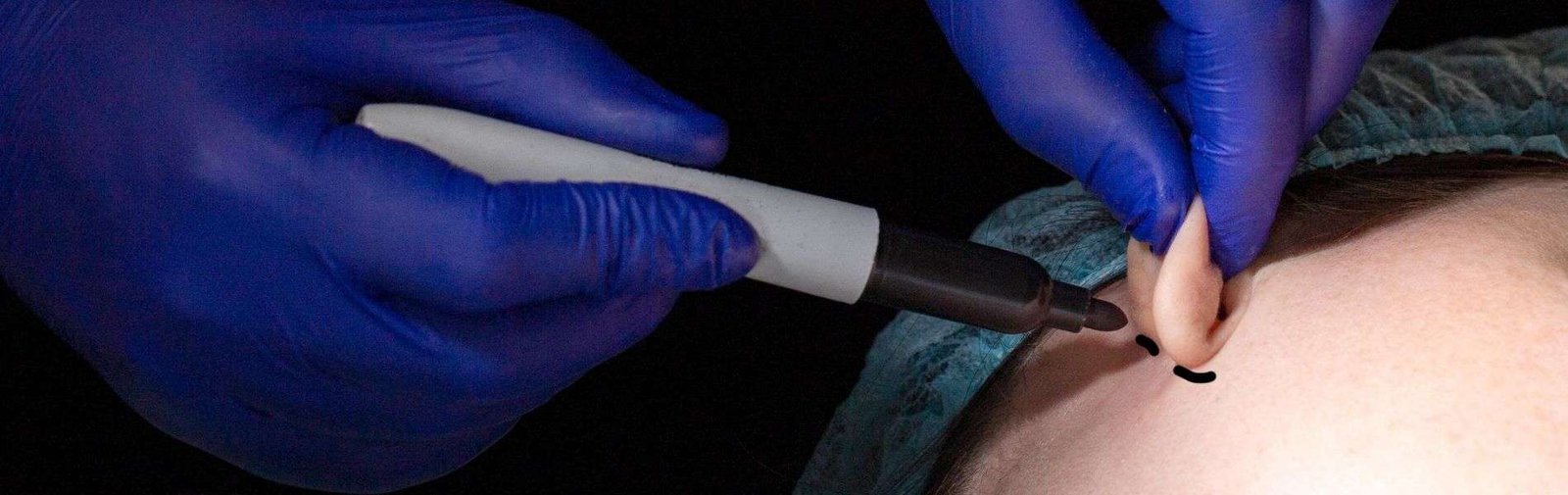 Otoplastia C - Otoplasty in Colombia