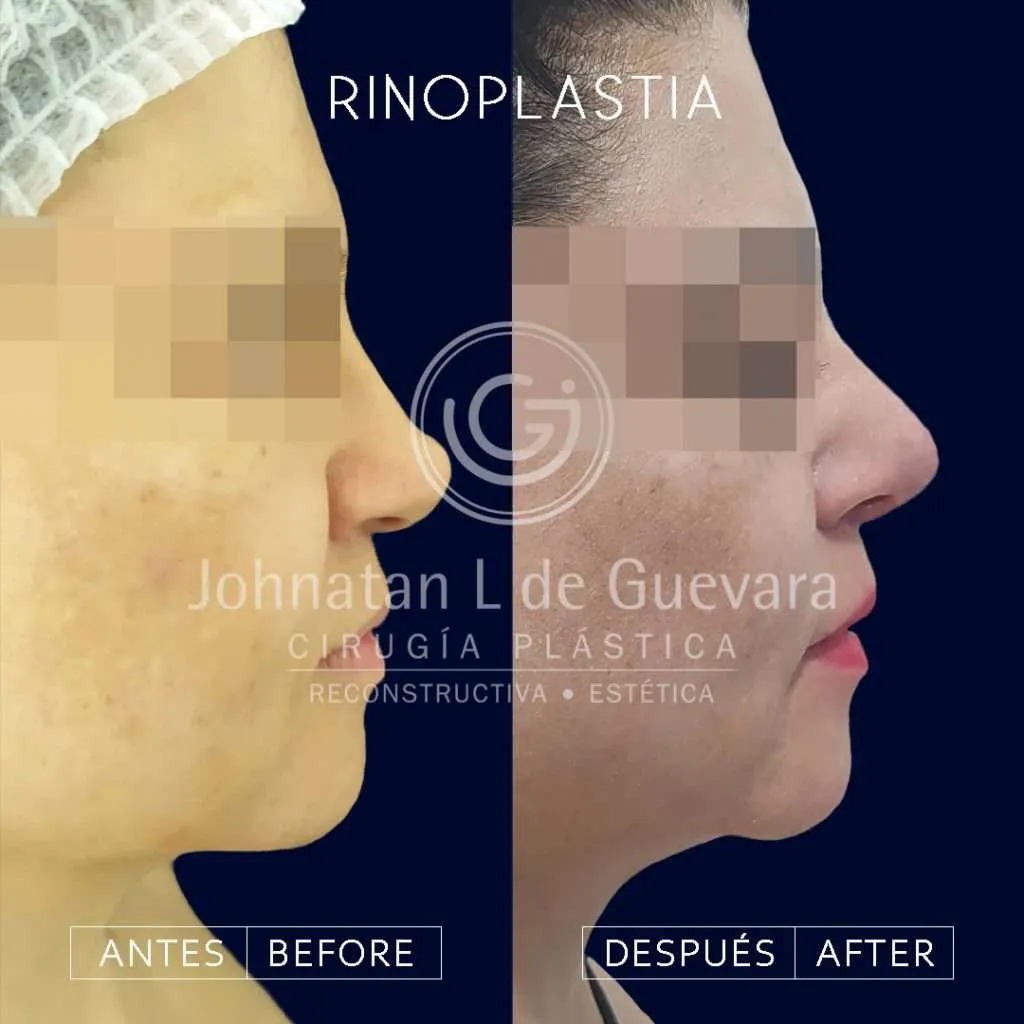 Rinoplastia 1