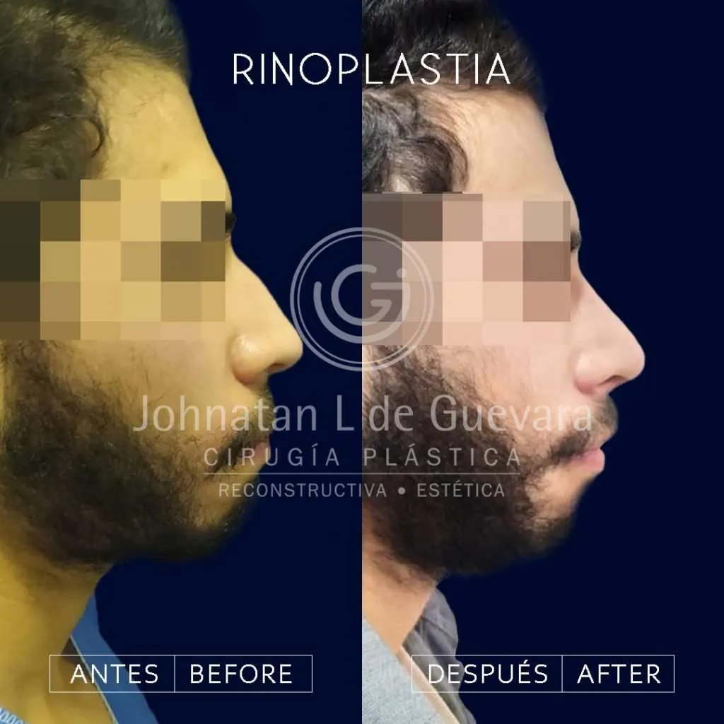 Rinoplastia 2