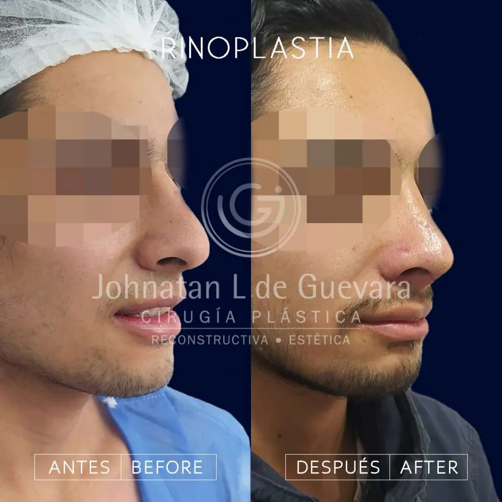 Rinoplastia 3