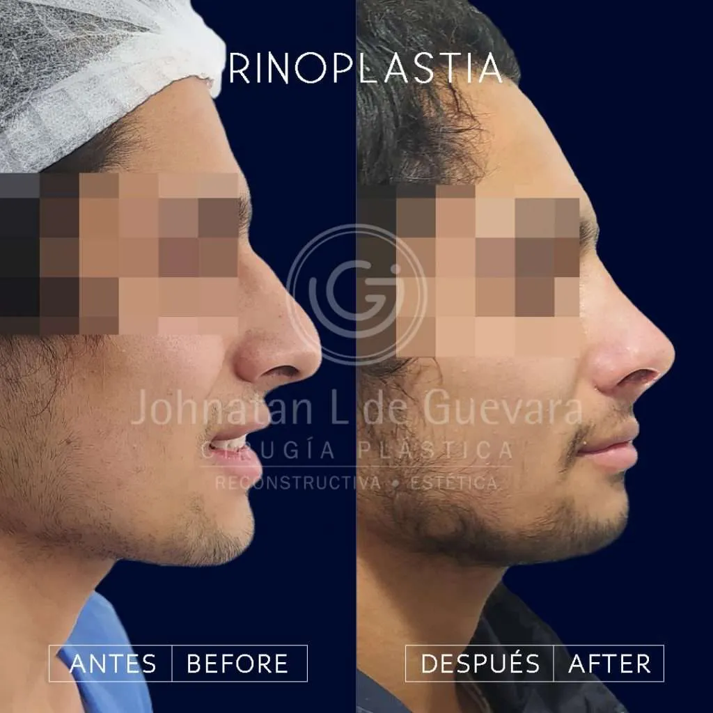 Rinoplastia 4